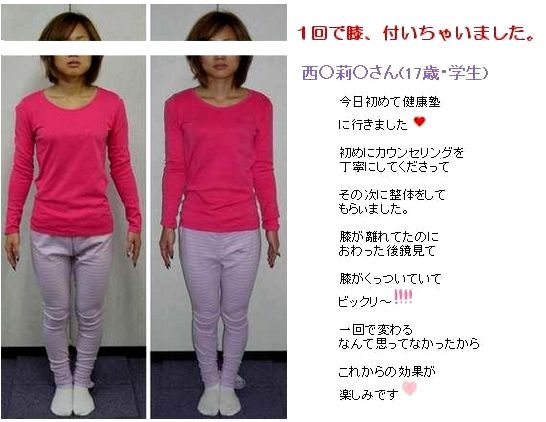O脚矯正施術例