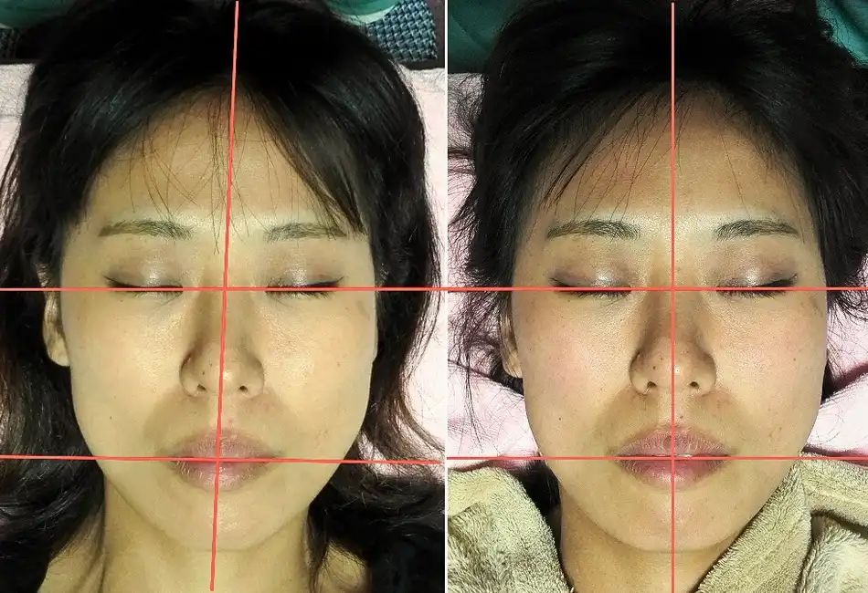 顔の歪み矯正で顎の歪み・エラの張りが改善したビフォーアフター写真