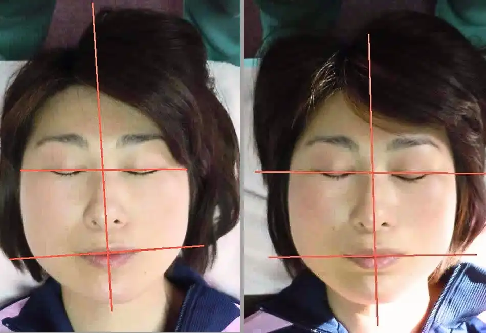 顔の歪み矯正による目の高さ・左右差のビフォーアフター改善例
