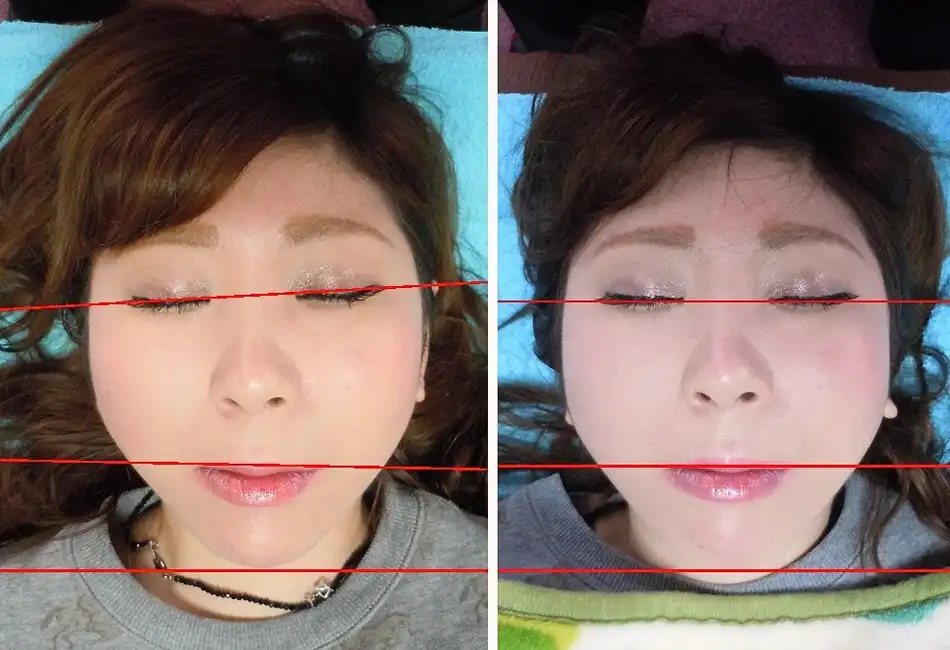 無痛整体による小顔・輪郭矯正のビフォーアフターとお客様の声