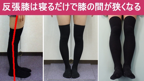 O脚判定の基準写真